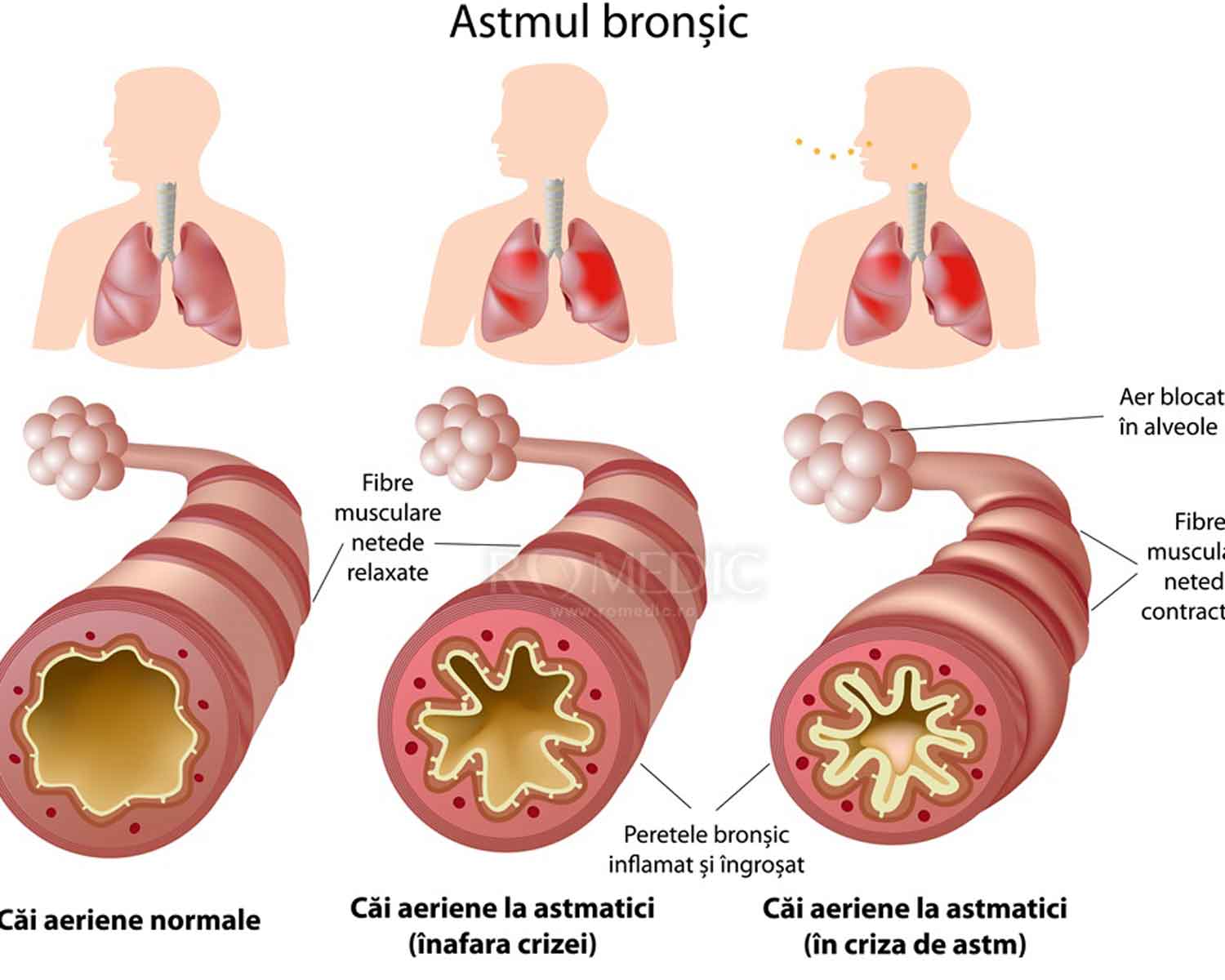 Astmul bronșic 